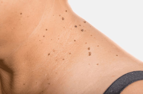 Are you looking for easy skin tag removal Soho - then contact Spire today!