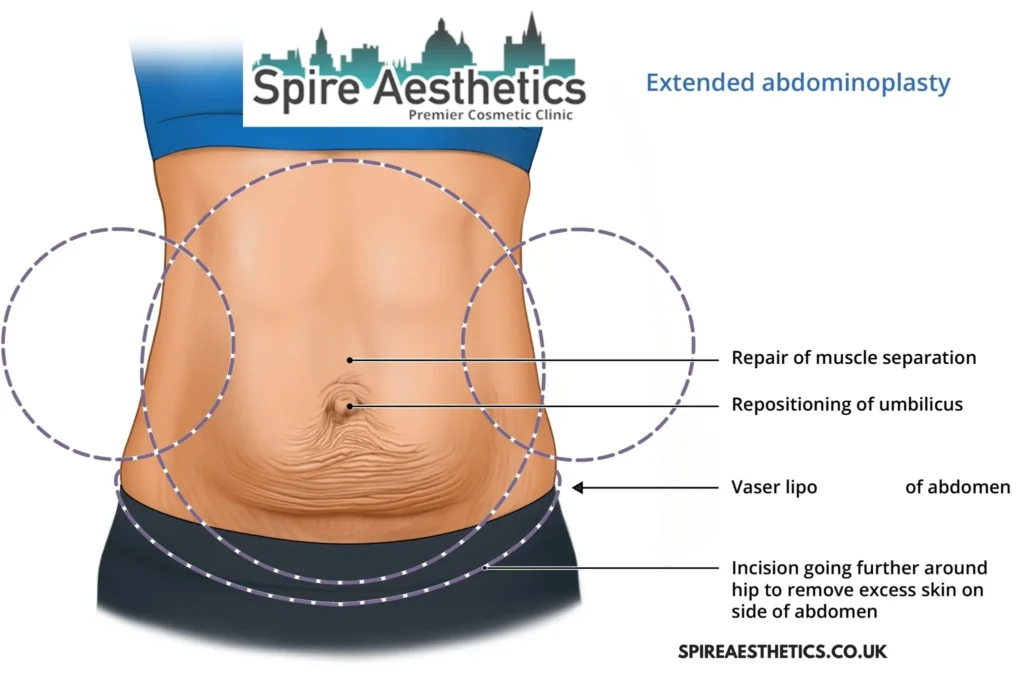Understanding Loose Skin After Gastric Band Soho Surgery and HIFU Treatment