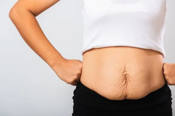 Image of a woman's stomach after weight loss with sagging skin following a gastric band Soho