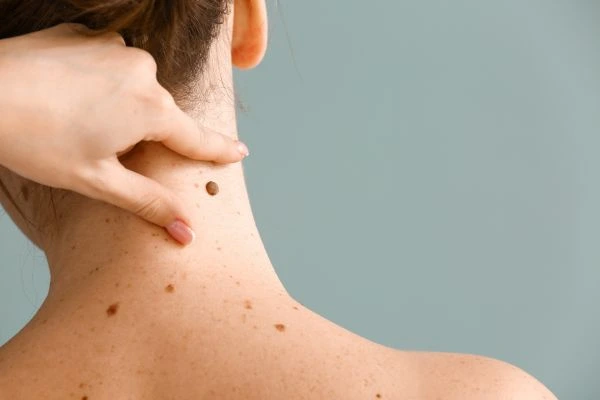 skin blemish removal Soho treatment