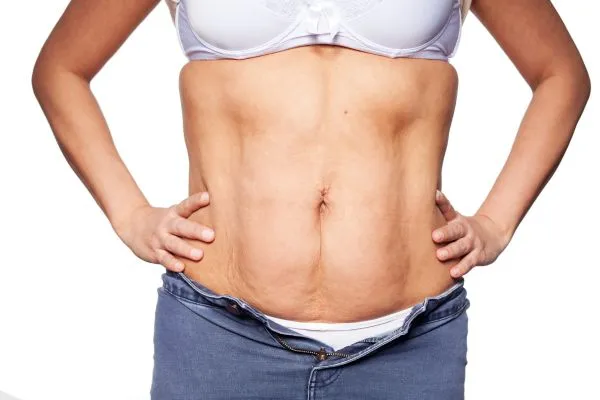 sagging skin on woman's stomach after weight loss injections Soho