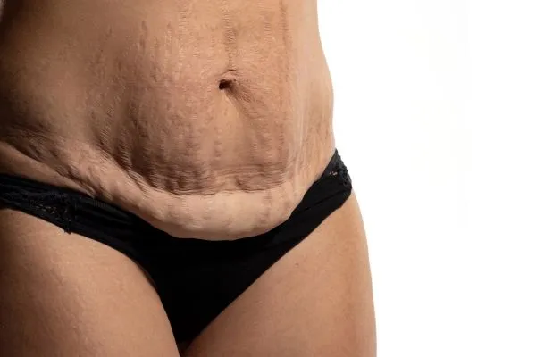 Image of womans stomach after weight loss injections Soho showing saggy skin
